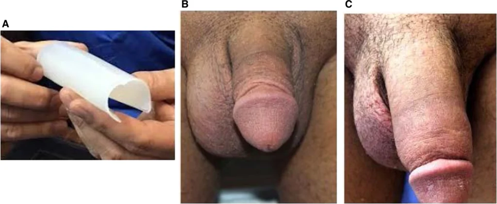 penisvergrößerung vorher nachher