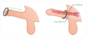 Aids for erectile dysfunction vacuum pump penis ring comparison