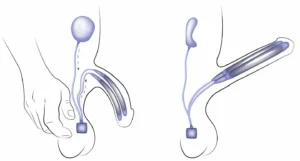 penispumpe erfahrung anwendung medizinische vakuumpumpe erklärung