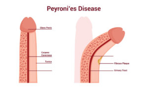 penispumpe vorher nachher vergleich bei peyronie krankheit penis krümmung grafik