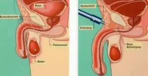 Vergleich Penisverdickung Methoden Hyaluron Operation Traktionstherapie