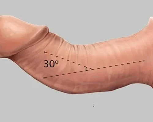 penis begradigen